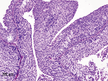 Imagen: Histopatología de un carcinoma urotelial de vejiga (Fotografía cortesía de Wikimedia Commons).